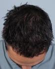 After Hair Transplant&nbsp;Front